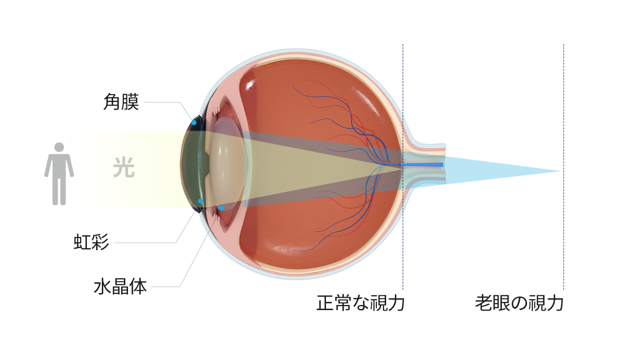 Presbyopia
