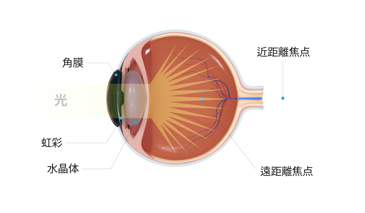 Cataract IOL